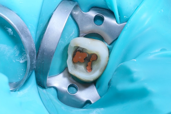 Common Endodontic Procedures