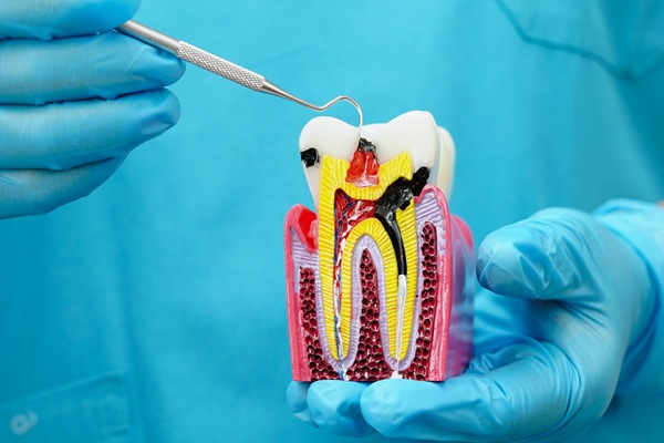 Tips To Prepare For Root Canal Treatment
